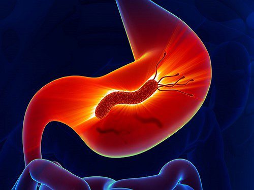 bệnh ung thư dạ dày có xu hướng ngày càng tăng