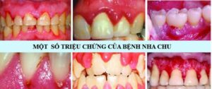 viem nha chu 1 e1597306970235 2