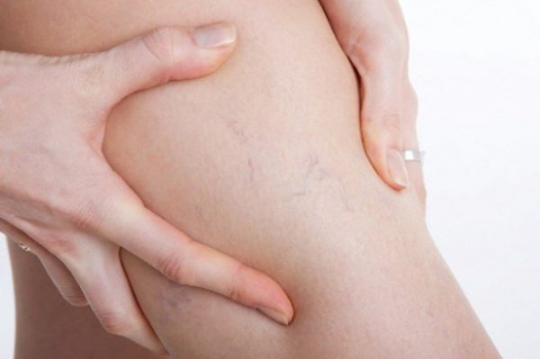 Biểu hiện viêm tắc tĩnh mạch