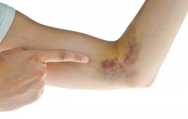 Thứ 4: Xuất huyết tiểu cầu miễn dịch