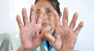 20210310 benh a sung la gi co dieu tri duoc khong