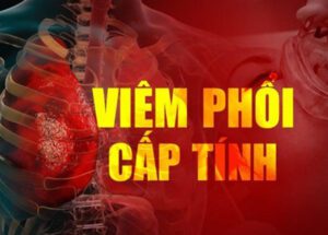 ViC3AAm phE1BB95i cE1BAA5p tC3ADnh cC3B3 thE1BB83 gC3A2y ra nhiE1BB81u biE1BABFn chE1BBA9ng nguy hiE1BB83m