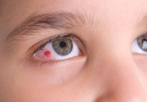 Điều trị và phòng ngừa bệnh viêm giác mạc thế nào?