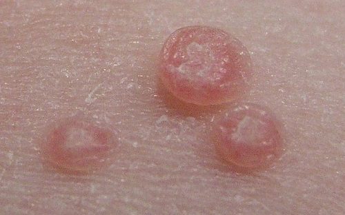 Phương pháp điều trị bệnh hột xoài