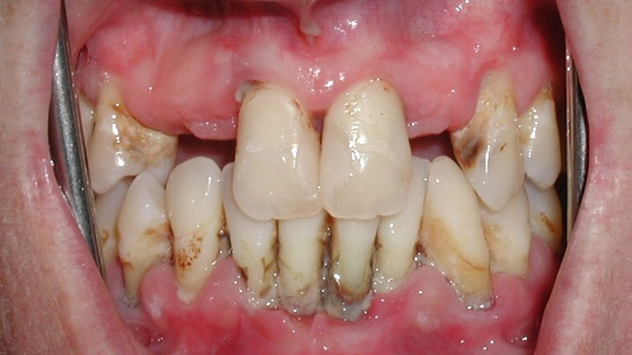 viem nha chu co the cay ghep implant duoc khong 2 1280x720 1 1