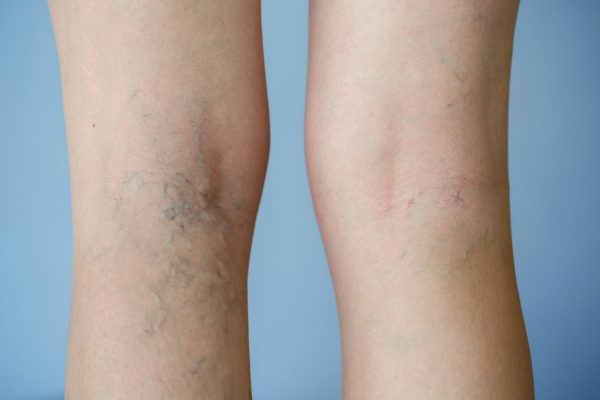 Thầy thuốc y học cổ truyền hướng dẫn trị viêm tắc tĩnh mạch