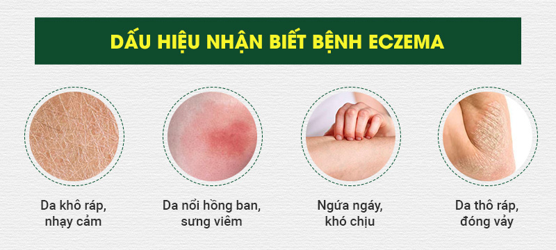 Tìm hiểu nguyên nhân và cách điều trị bệnh eczema