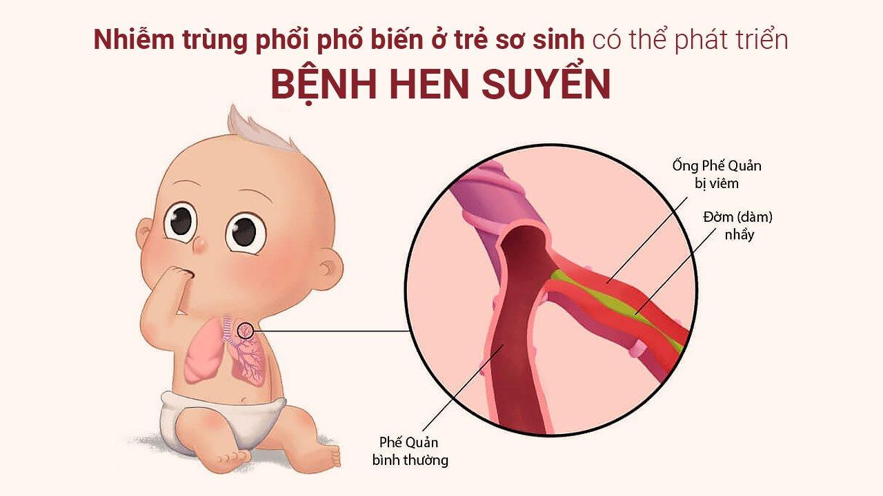 hen suyễn ở trẻ