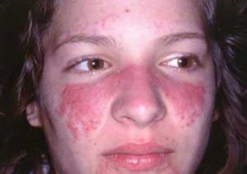 nhung dau hieu nhan biet benh lupus ban do 54