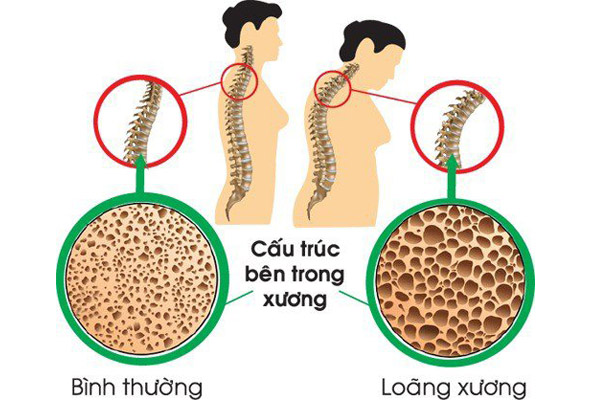 Phụ nữ thường có nguy cơ loãng xương cao hơn nam giới