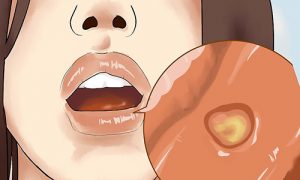 Bệnh viêm loét miệng do nguyên nhân nào gây nên ?