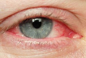 Cách nhận biết bệnh đau mắt đỏ như thế nào?