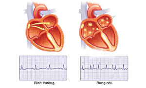 Những điều bạn chưa biết về bệnh rung nhĩ - rối loạn nhịp tim
