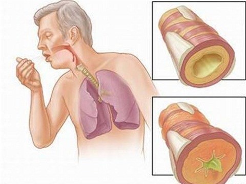Ung thư phổi ít gây ra triệu chứng ở giai đoạn đầu