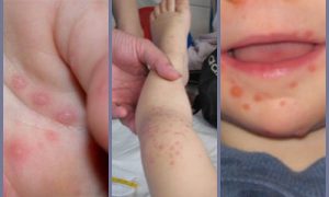 Bệnh chân tay miệng ở trẻ nhỏ