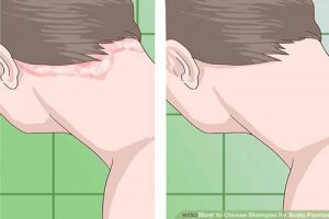 Có thể nhận biết biết sớm bệnh vẩy nến da đầu không?