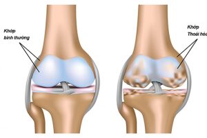 Dược sĩ mách những thực phẩm tốt cho khớp gối mà bạn chưa biết
