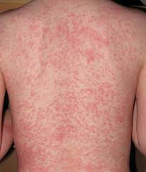 Viêm da tiếp xúc gây mẩn ngứa khó chịu cho người bệnh