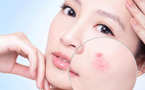 Chuyên gia da liễu hướng dẫn điều trị mụn trứng cá một cách khoa học