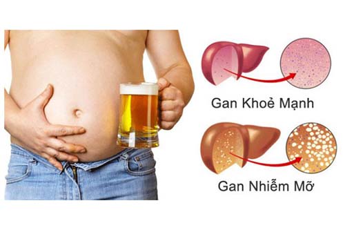 Người bị gan nhiễm mỡ cần lưu ý tới chế độ ăn uống sinh hoạt để mau khỏi bệnh