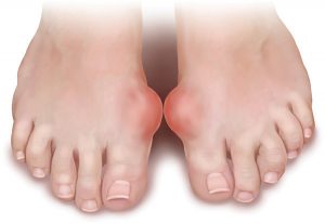 Bệnh gout - Bệnh nhà giàu