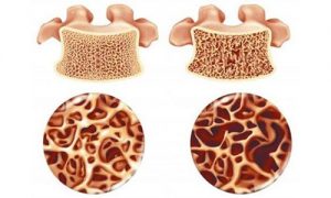 Những biện pháp nào để có thể tránh khỏi loãng xương?