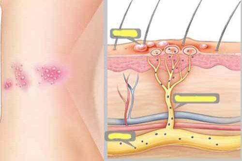 Những nguyên nhân nào dẫn đến bệnh zona thần kinh?