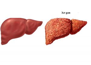 Những thực phẩm tuy bổ dưỡng nhưng lại có hại với bệnh nhân xơ gan