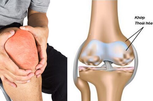 Cần phát hiện sớm tình trạng thoái hoa khớp gối