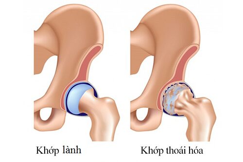 Chuyên gia Điều dưỡng hướng dẫn 3 cách điều trị thoái hóa khớp háng