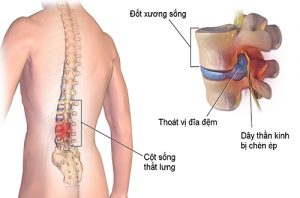 Thoát vị đĩa đệm cột sống thắt lưng phổ biến ở nhiều người