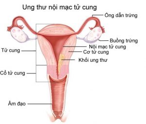Bật mí những người dễ mắc ung thư nội mạc tử cung