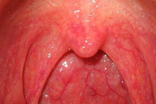 Viêm họng xung huyết và những điều cần biết về bệnh 