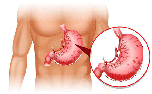10 dấu hiệu cảnh báo nguy cơ mắc bệnh viêm dạ dày