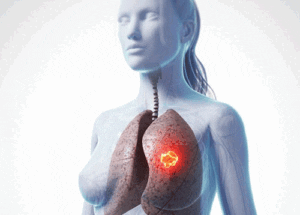 ung thu phoi o nu gioi 1 54