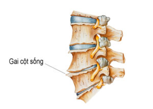 Các dấu hiệu gai cột sống chèn dây thần kinh