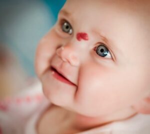 Bớt chàm đỏ thường có màu đỏ rất dễ nhận biết