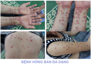 Những triệu chứng của bệnh hồng ban đa dạng