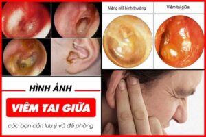 Nguyên nhân và cách phòng ngừa viêm tai giữa