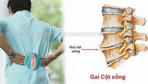 Các dấu hiệu gai cột sống chèn dây thần kinh