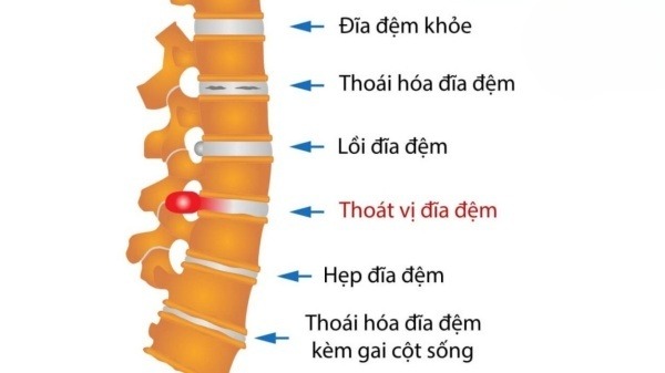 Giai đoạn đau cấp khi bị thoát vị đĩa đệm lưng