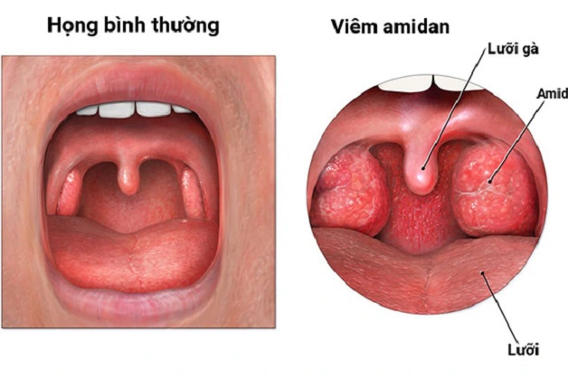 viêm Amidan ở trẻ em