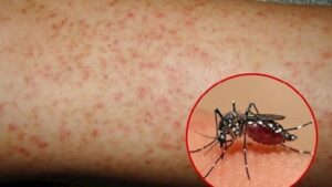 Cập nhật phác đồ chữa trị sốt Dengue mới nhất