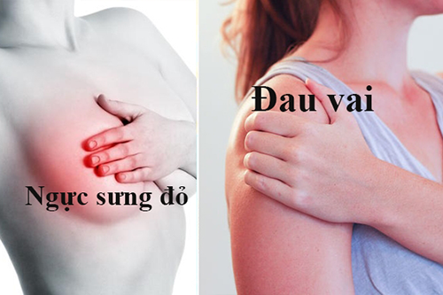Không nên chủ quan bỏ qua các cơn đau lưng đau vai