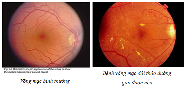 Cảnh báo nguy cơ mắc chứng võng mạc của bệnh nhân tiểu đường