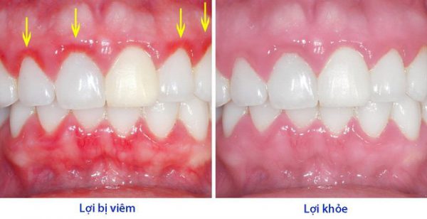 Biểu hiện của viêm chân răng