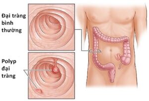 Polyp trực trạng với những nguyên nhân ít ai biết đến