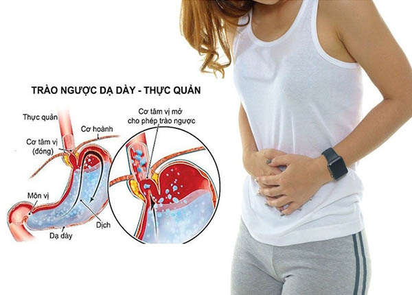 Benh trao nguoc da day co nguy hiem khong 1