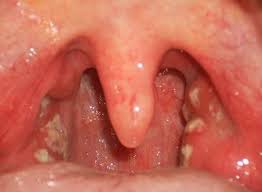 Bài thuốc dân gian trị viêm họng hiệu quả