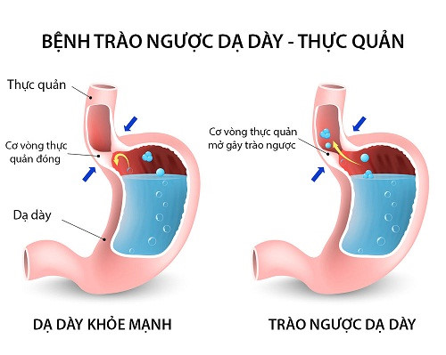 Bật mí 5 vị thuốc quý chữa bệnh trào ngược dạ dày